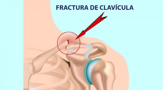 Lesiones principales de hombro: Fractura del hombro