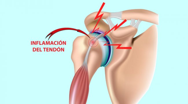 Lesiones principales de hombro: Tendinitis del biceps