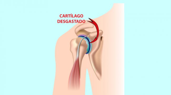 Lesiones principales de hombro: Artrosis