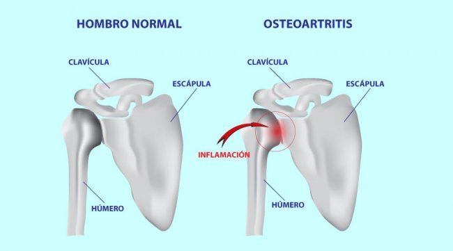 Lesiones principales de hombro: Reumatismo