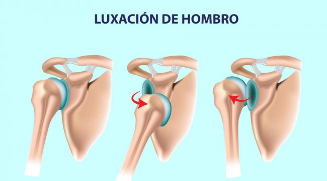 Lesiones principales de hombro: Luxación de hombro