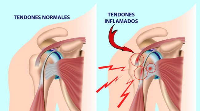 Lesiones principales de hombro: Manguito Rotador