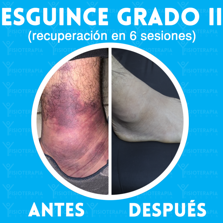 Fisioterapia Heredia Esguince de tobillo grado II documentado Fisioterapia Heredia Esguince de tobillo grado II documentado