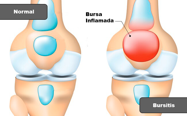 ¿Qué son las bursas?